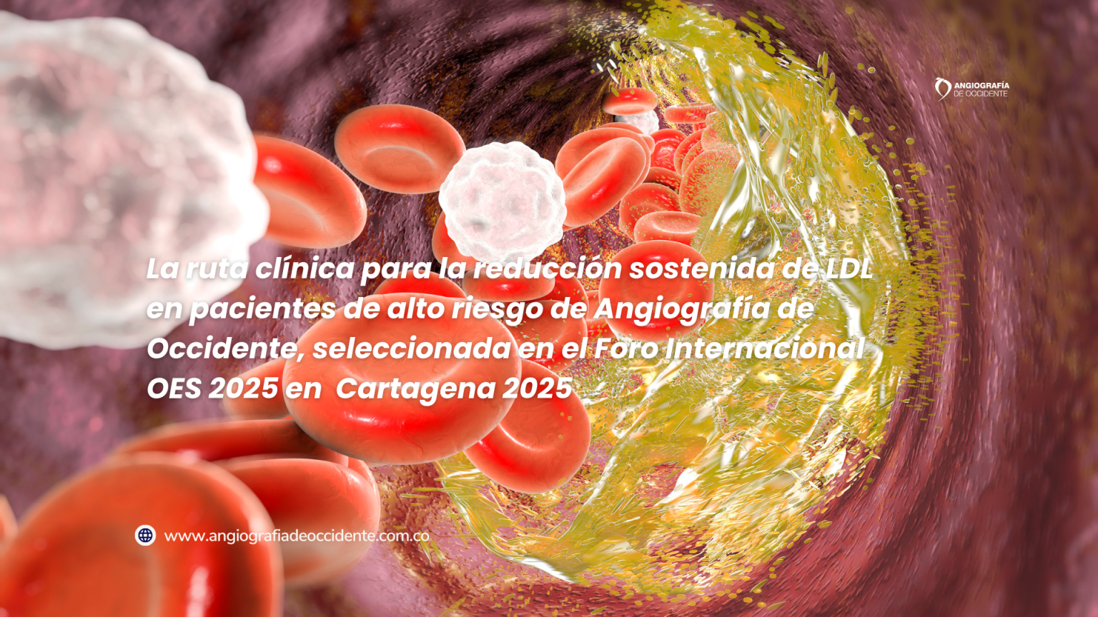 La ruta clínica para la reducción sostenida de LDL en pacientes de alto riesgo de Angiografía de Occidente, seleccionada en el Foro Internacional OES 2025 en Cartagena 2025